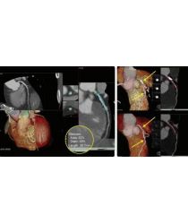 CT / MRI rekonstrukcijas darba stacija Vital Vitrea