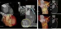 CT / MRI rekonstrukcijas darba stacija Vital Vitrea